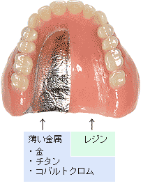 健康保険の入れ歯と、自由診療の入れ歯