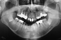 顎骨嚢胞の症例