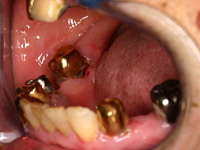 歯肉癌（初期）の症例