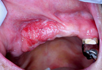 歯肉癌（中期癌）の症例