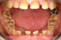 歯ぎしりで歯が擦り減った症例