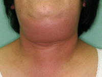 顎下部、頚部蜂巣炎の症例