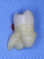 根が肥大した歯の例(2)