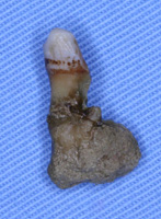 根が肥大した歯の例(3)