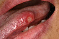 アフタ（口内炎）の症例