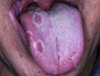 地図状舌の症例