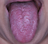 溝状舌の症例