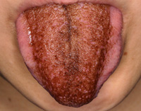 黒毛舌の症例