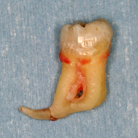 根が湾曲した歯の例(1)