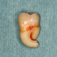 根が湾曲した歯の例(2)