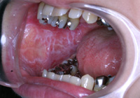 扁平苔癬の症例