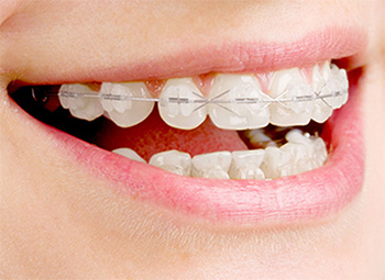 歯列不正の原因と、治療の方法
